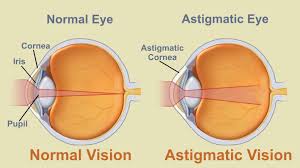Apa itu astigmatism?